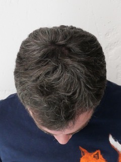 Capilclinic Resultado 6 meses después  Injerto.jpg