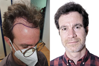 Antes y Después Capilclinic.jpg