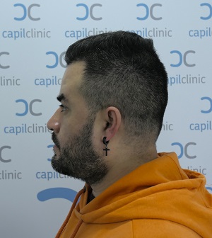 Resultado Injerto Capilar.jpg