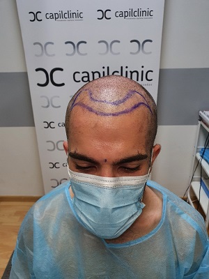 Antes del Injerto Capilclinic.jpg