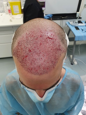Depués del injerto Capilclinic.jpg