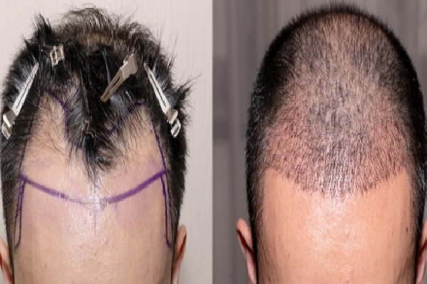 postoperatorio-injerto-de-pelo.jpg
